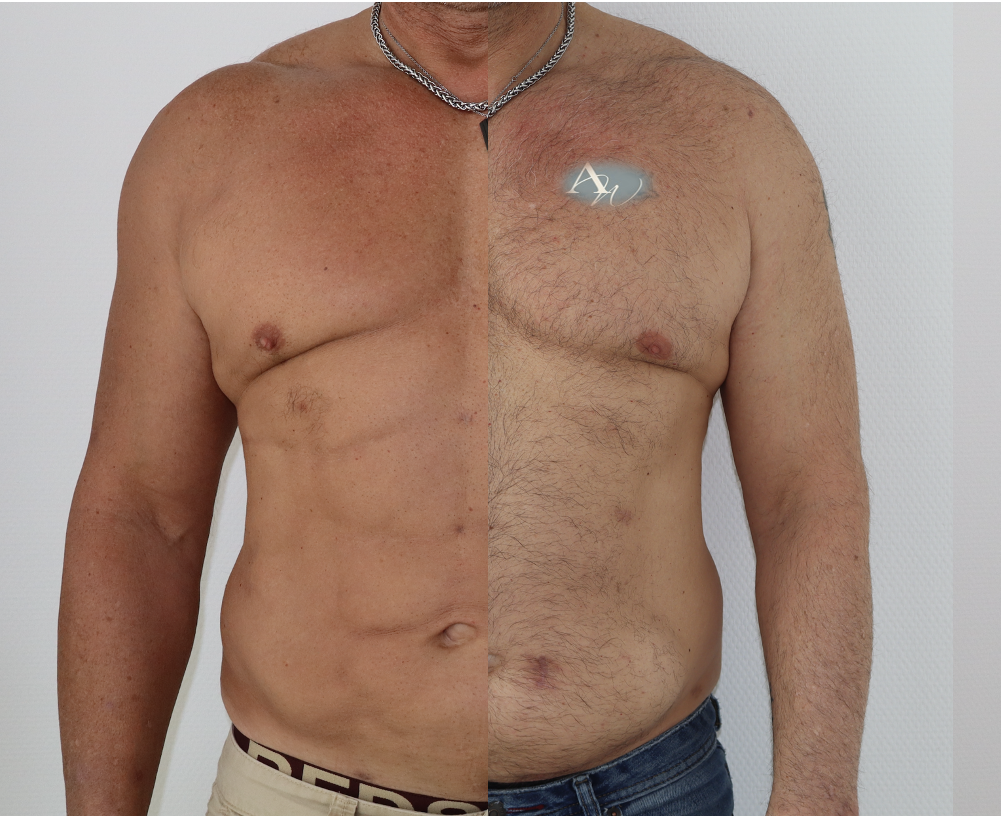 Avant/Après lipoaspiration flancs abdomen